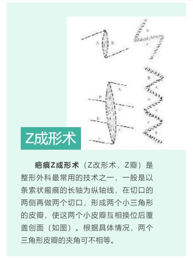 z成形术 疤痕z成形术(z改形术,z瓣)是整形外科最常用的技术之一,一般