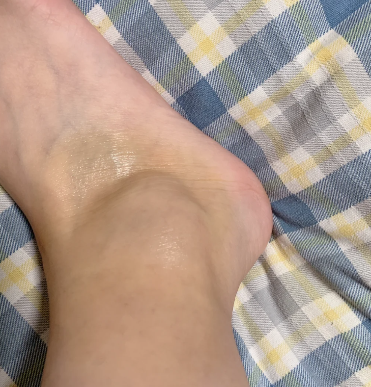 为什么崴脚了休息一晚脚更疼,慢慢走多了又不那么疼了为什么在线