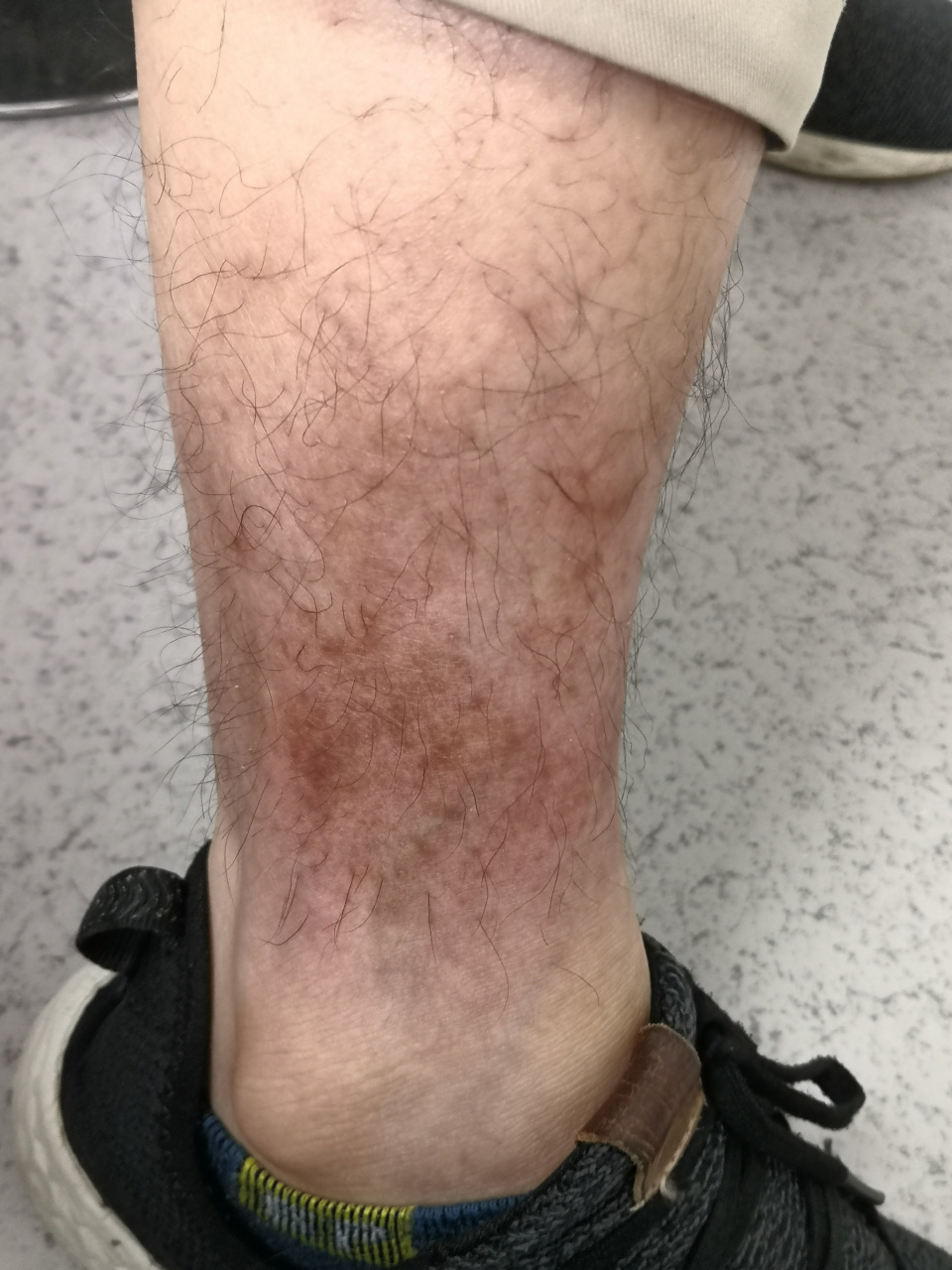 小腿皮炎症状.恢复期的色素沉着过度症状#皮炎