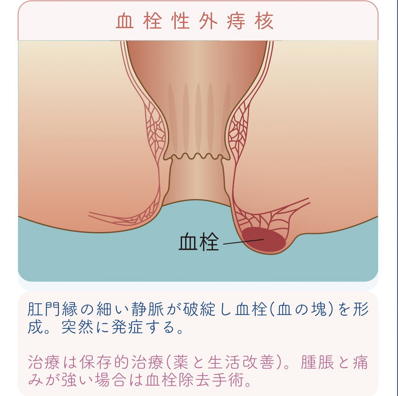 继续分享 痔疮到什么程度需要手术治疗 痔本身属于良性病变,除会影响