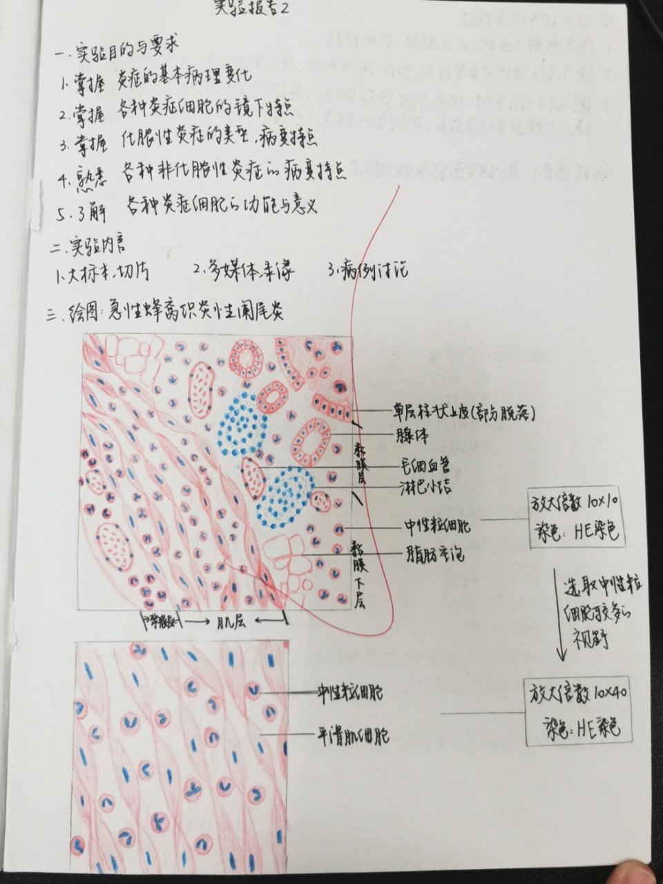 病理实验红蓝铅笔图2—急性蜂窝织炎阑尾炎 【急性蜂窝织炎性阑尾炎】