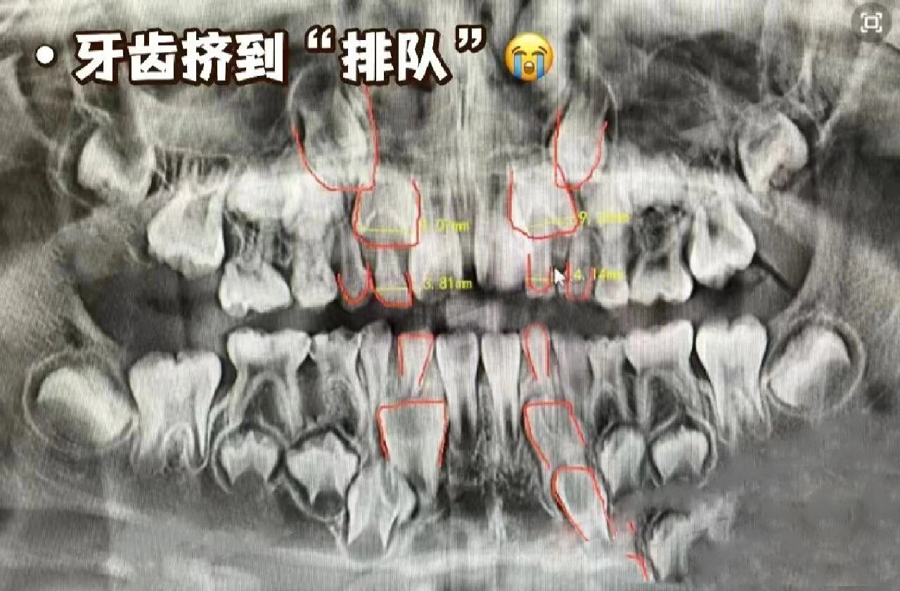 给大家看看6岁换牙期孩子的牙片