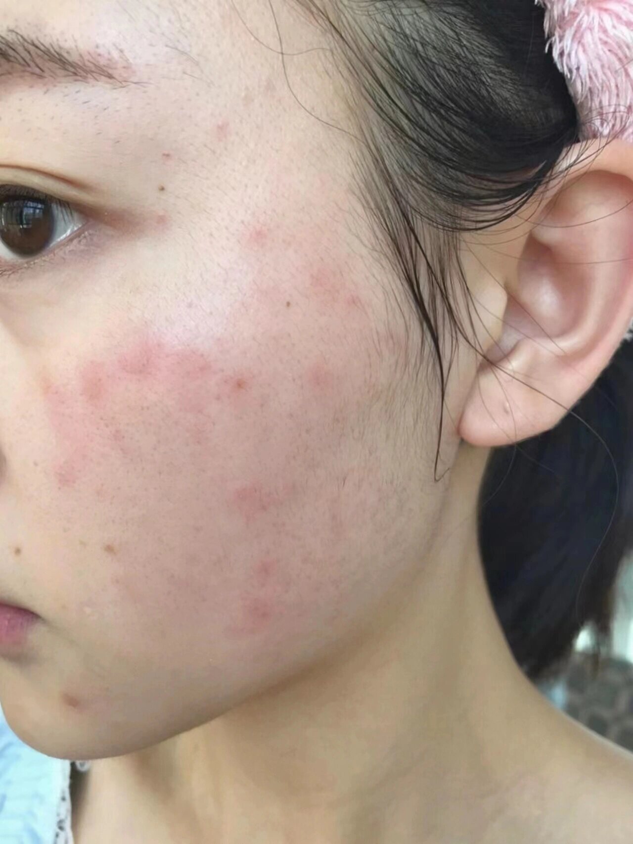 重度过敏脸终于上岸了!