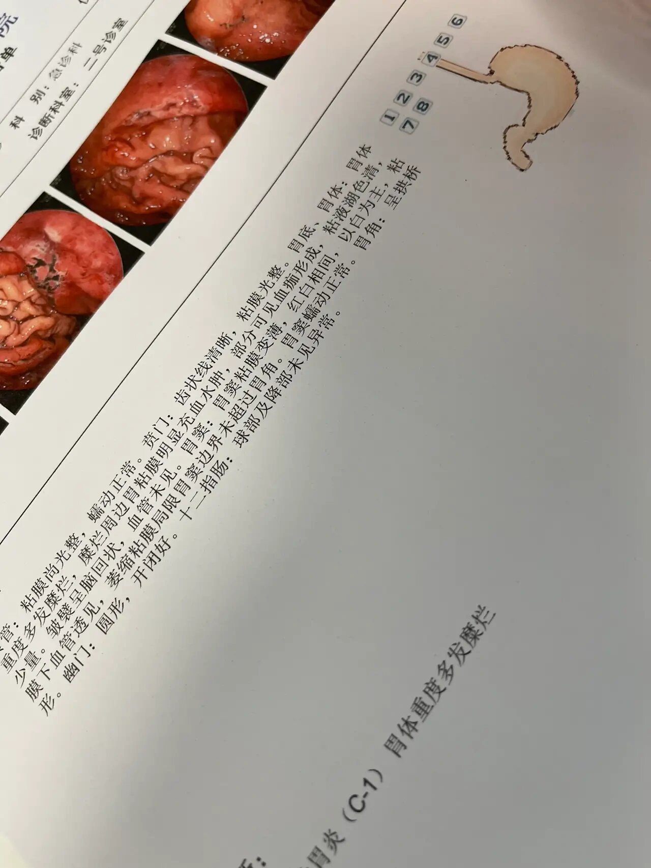 呕吐 诊疗记录胃肠住院图片吐血医院单子喝多吐血住院的真实照片喝酒