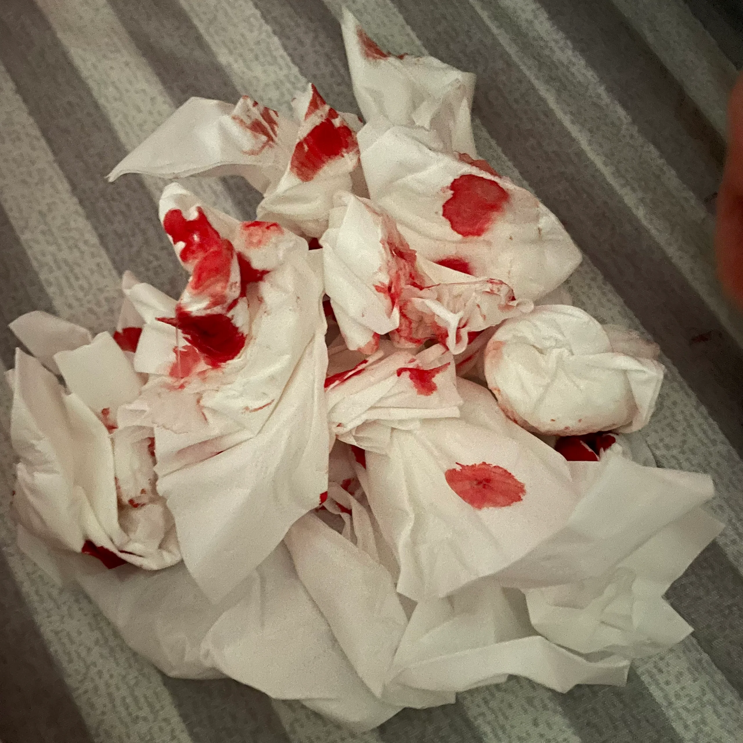 儿童流鼻血!快速止鼻血方法!