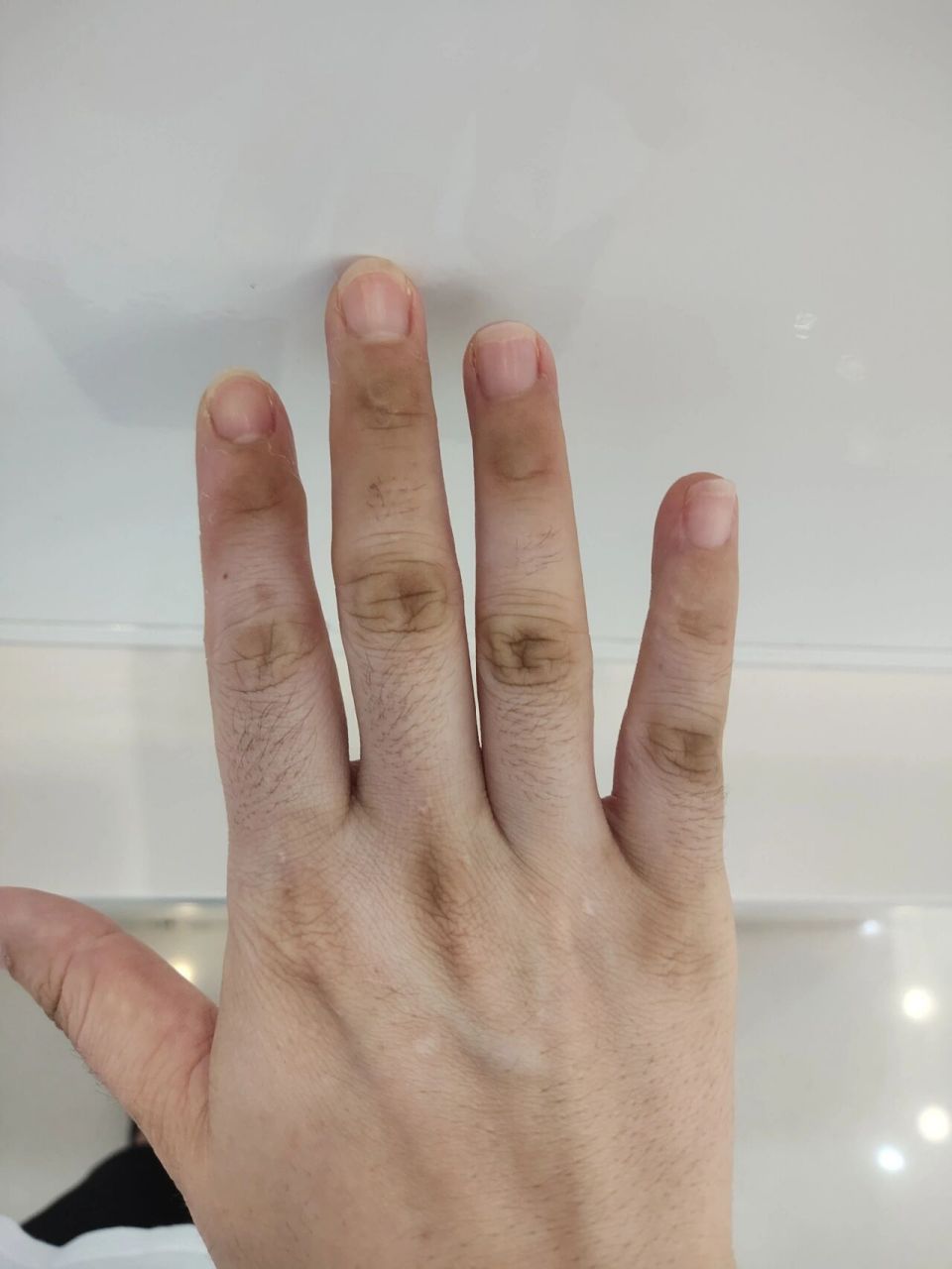 指关节发黑 之前我的手指关节比这个还黑,现在慢慢