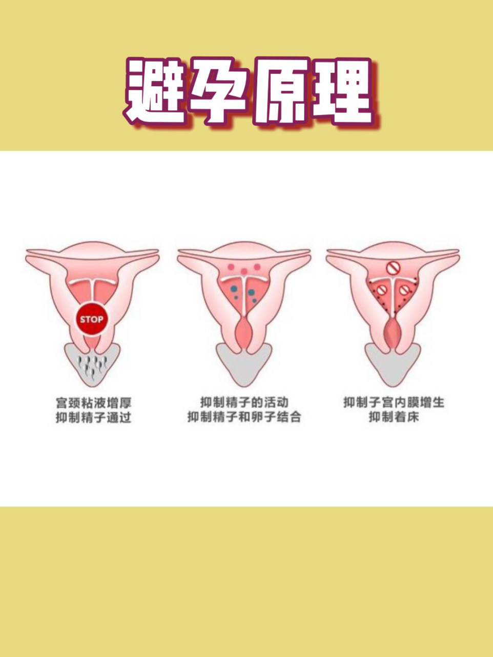 你不知道的节育环|👏🏻上环全攻略‼️ ✨节育环避孕原理