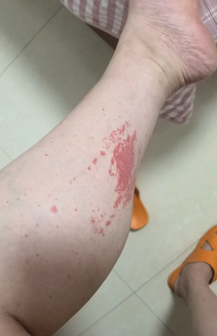 皮下出血呈现紫红色通常和血管破裂或血液问题有关