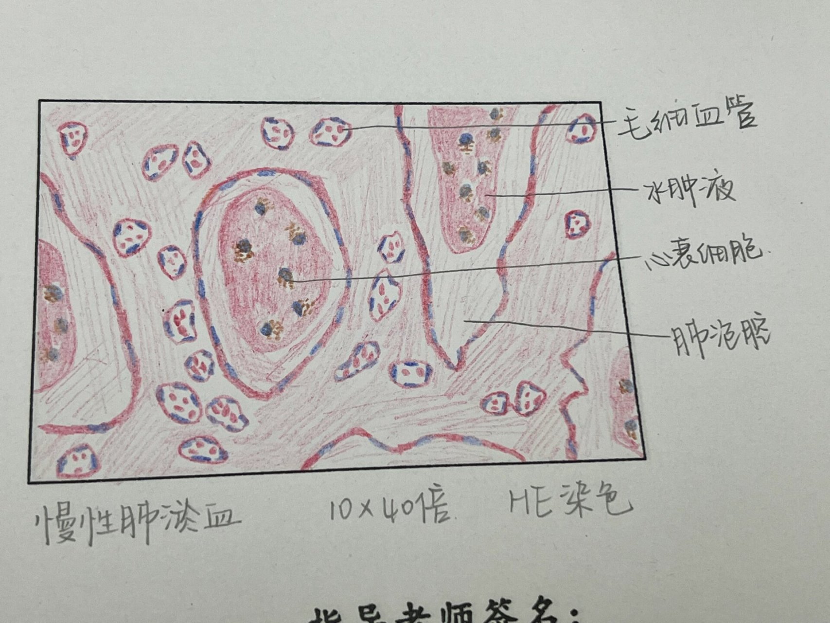 肺淤血绘图图片