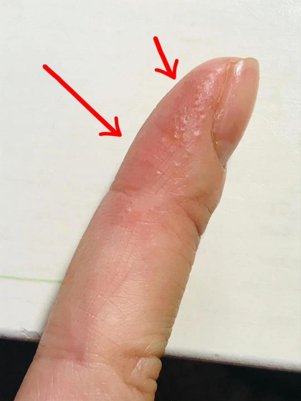 给所有爱长汗疱疹的姐妹说个方法!