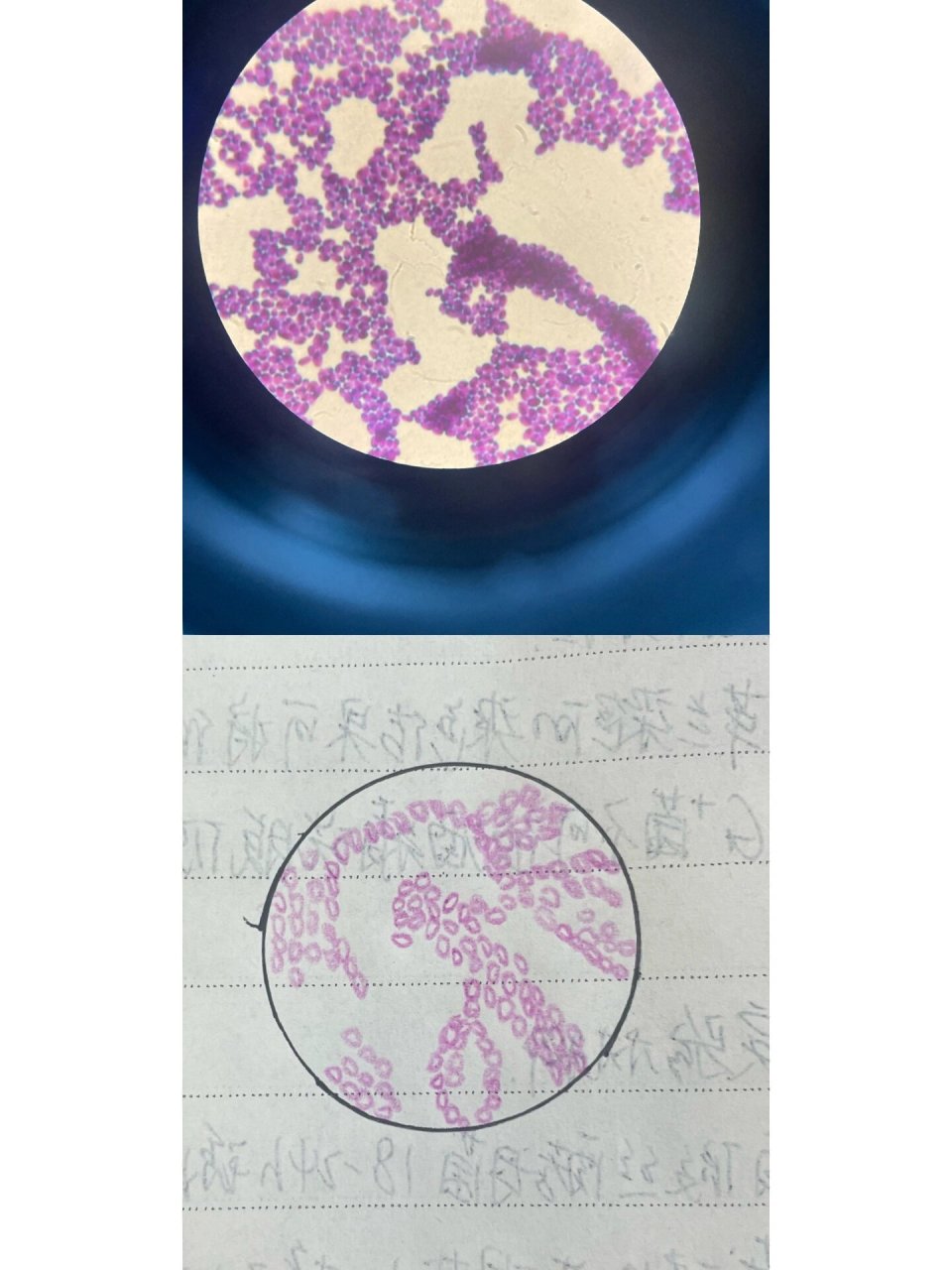 微生物结核杆菌抗酸和白假丝酵母菌手绘图 p1可疑肺结核患者痰涂片