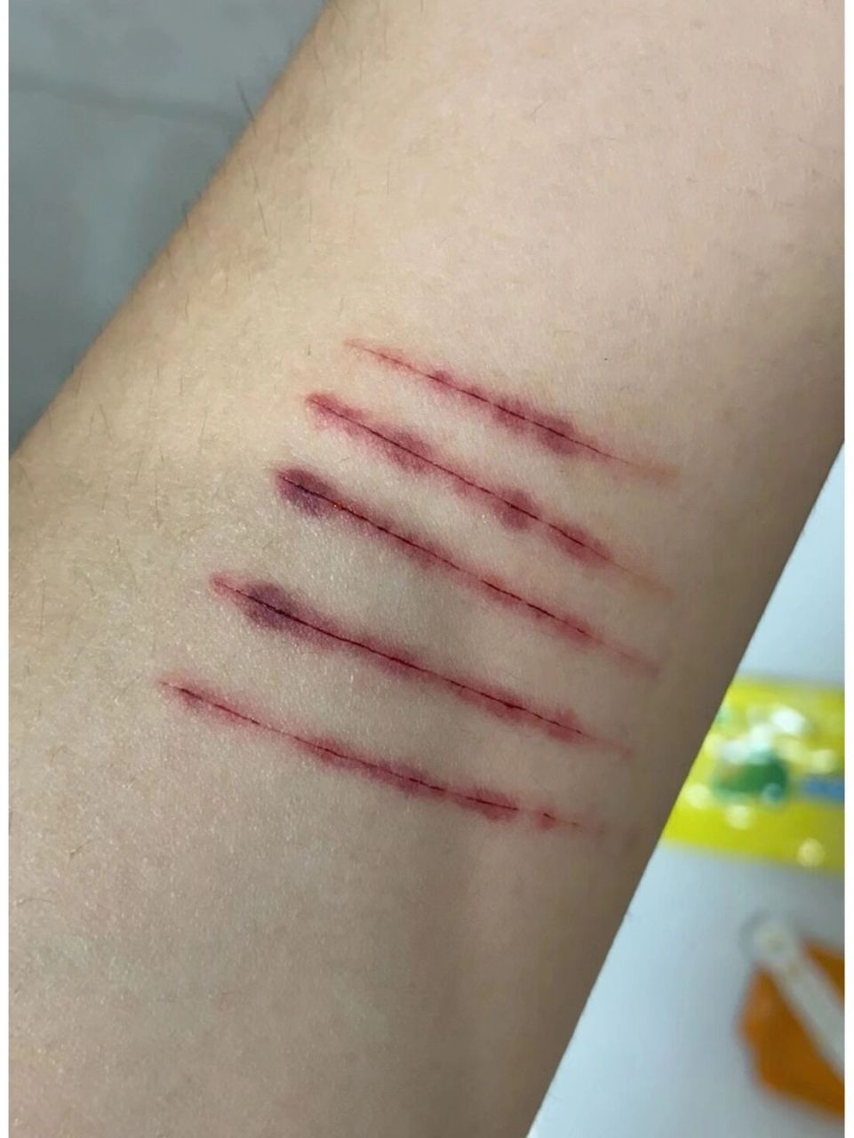 孩子自残怎么办?