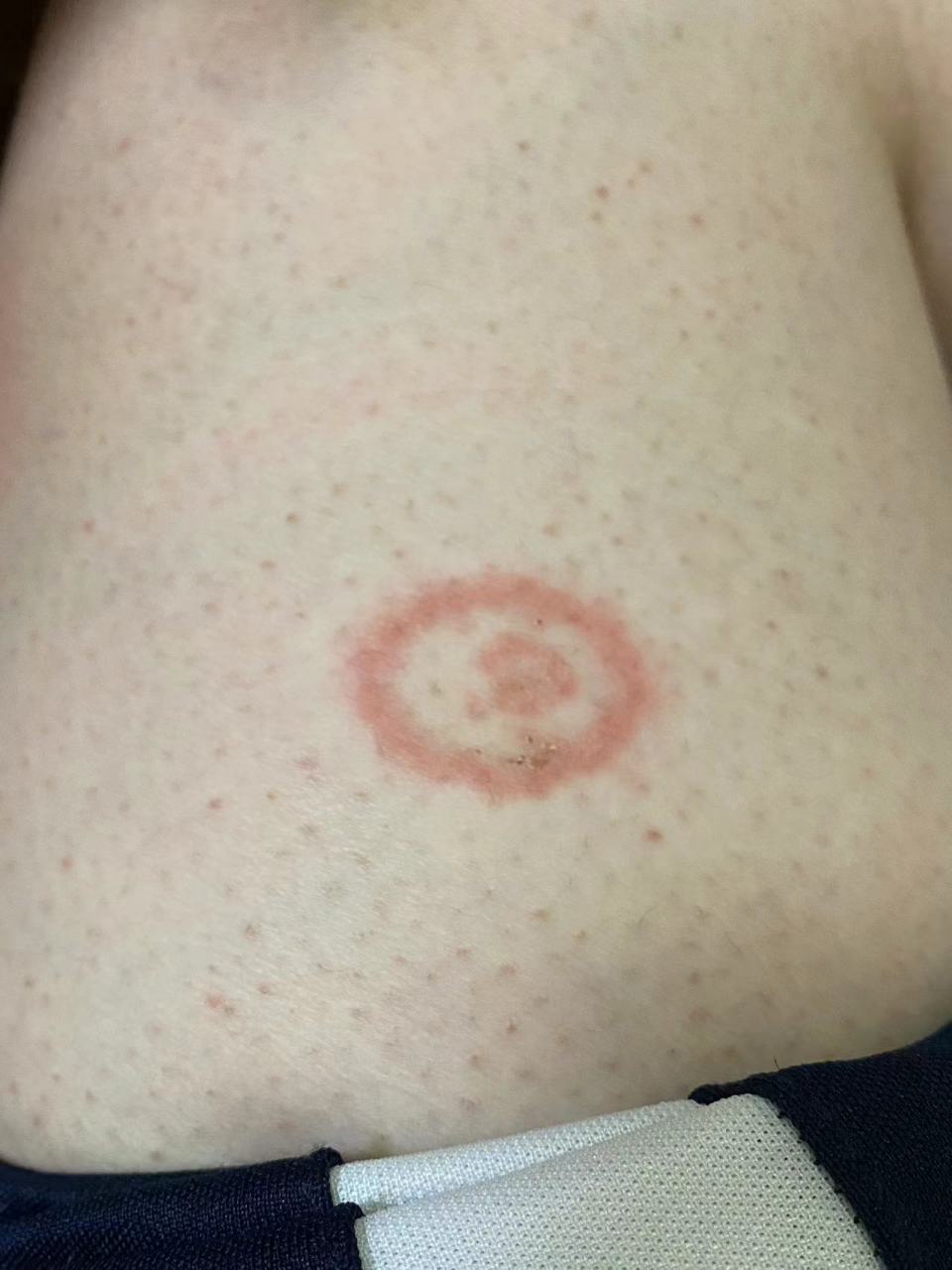 体癣典型症状#体癣##真菌