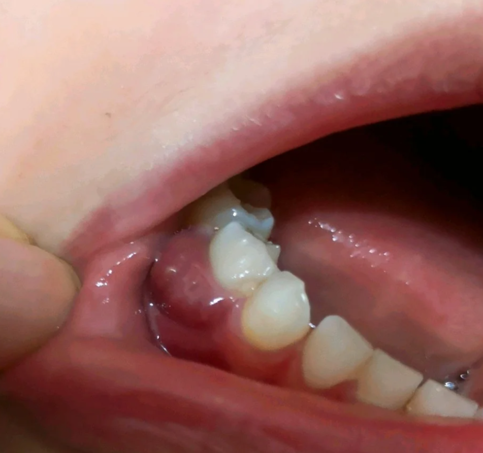 根管治疗后牙龈长脓包,最常见的原因是感染或根管治疗失败