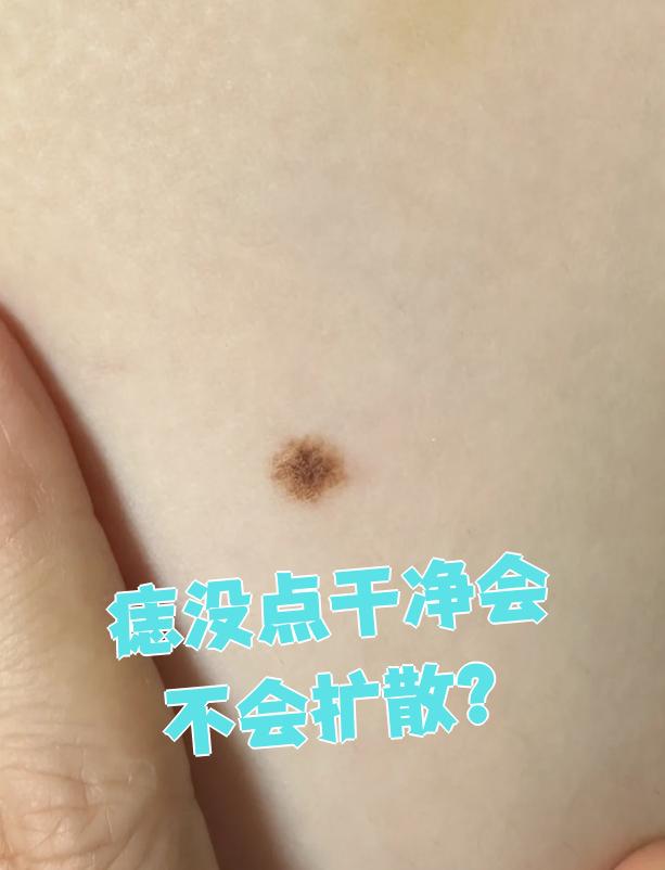 普通色素痣一般不会扩散,但皮脂腺痣或恶性痣有可能扩散