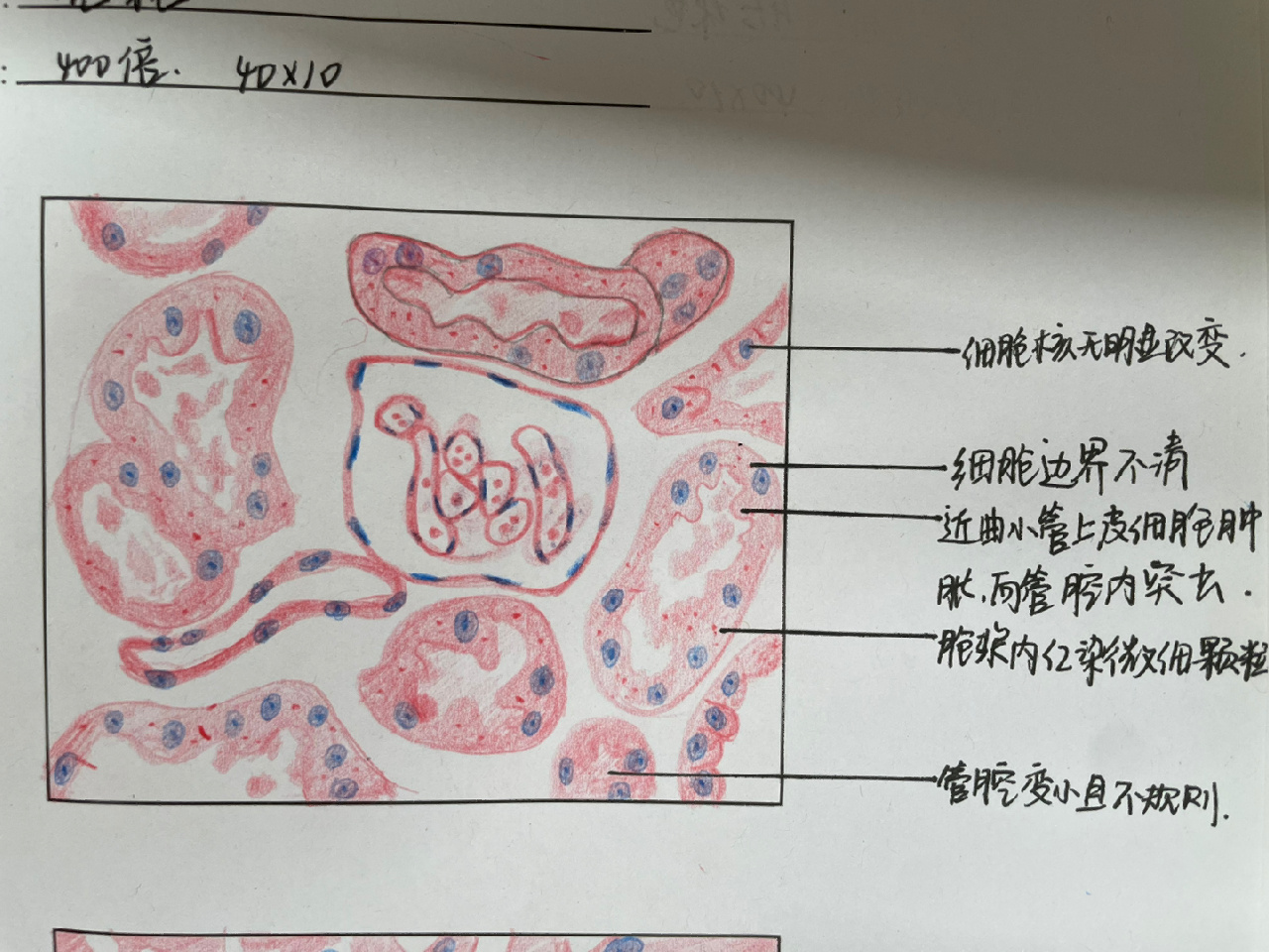 病理学手绘图分享 病理学切片手绘图分享～ p2:肾小管上皮细胞水肿 p3