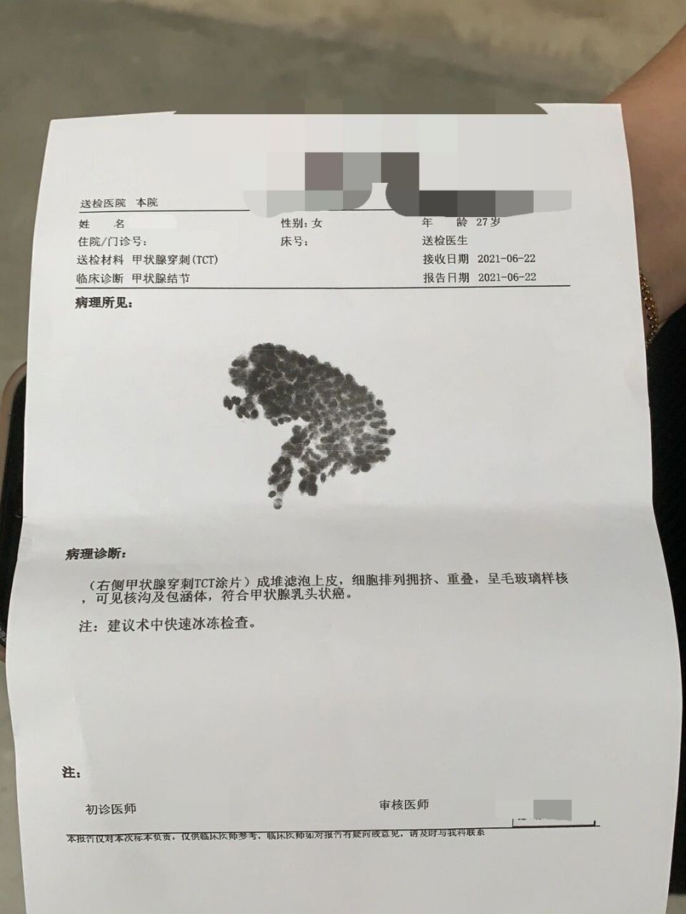 甲狀腺ca 今天去拿了穿刺報告,顯示甲狀腺乳頭狀癌.