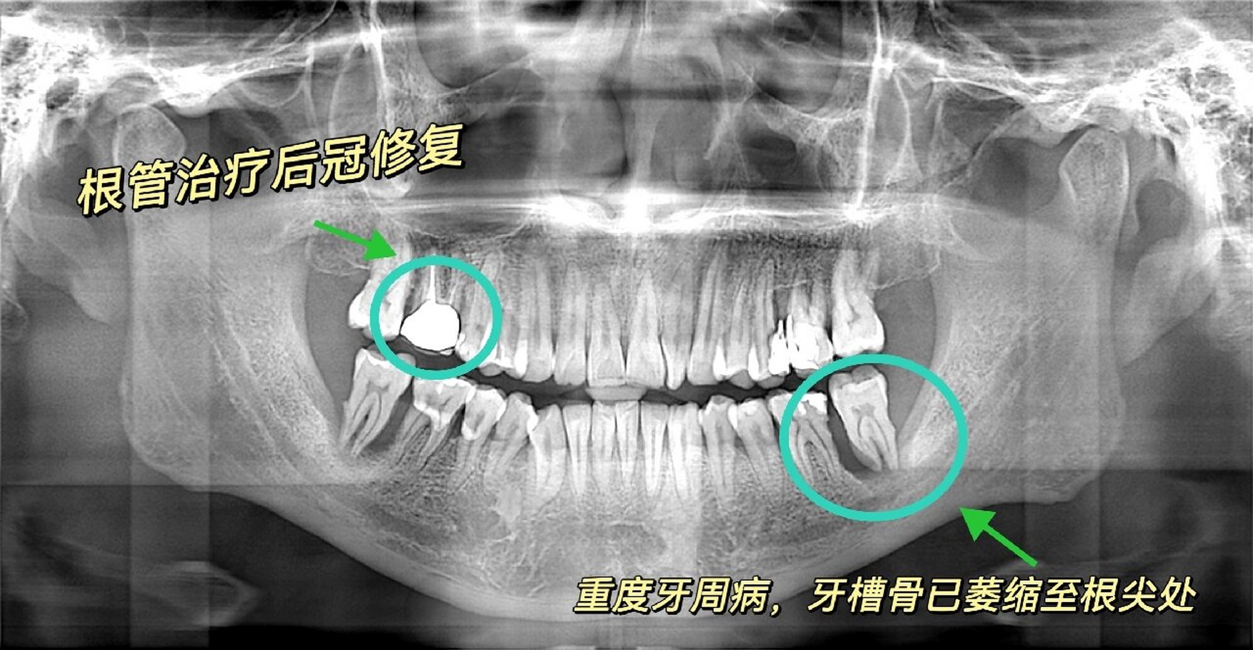 教你一分钟看懂口腔全景片90 口腔全景片又称曲面断层片,是口腔临床
