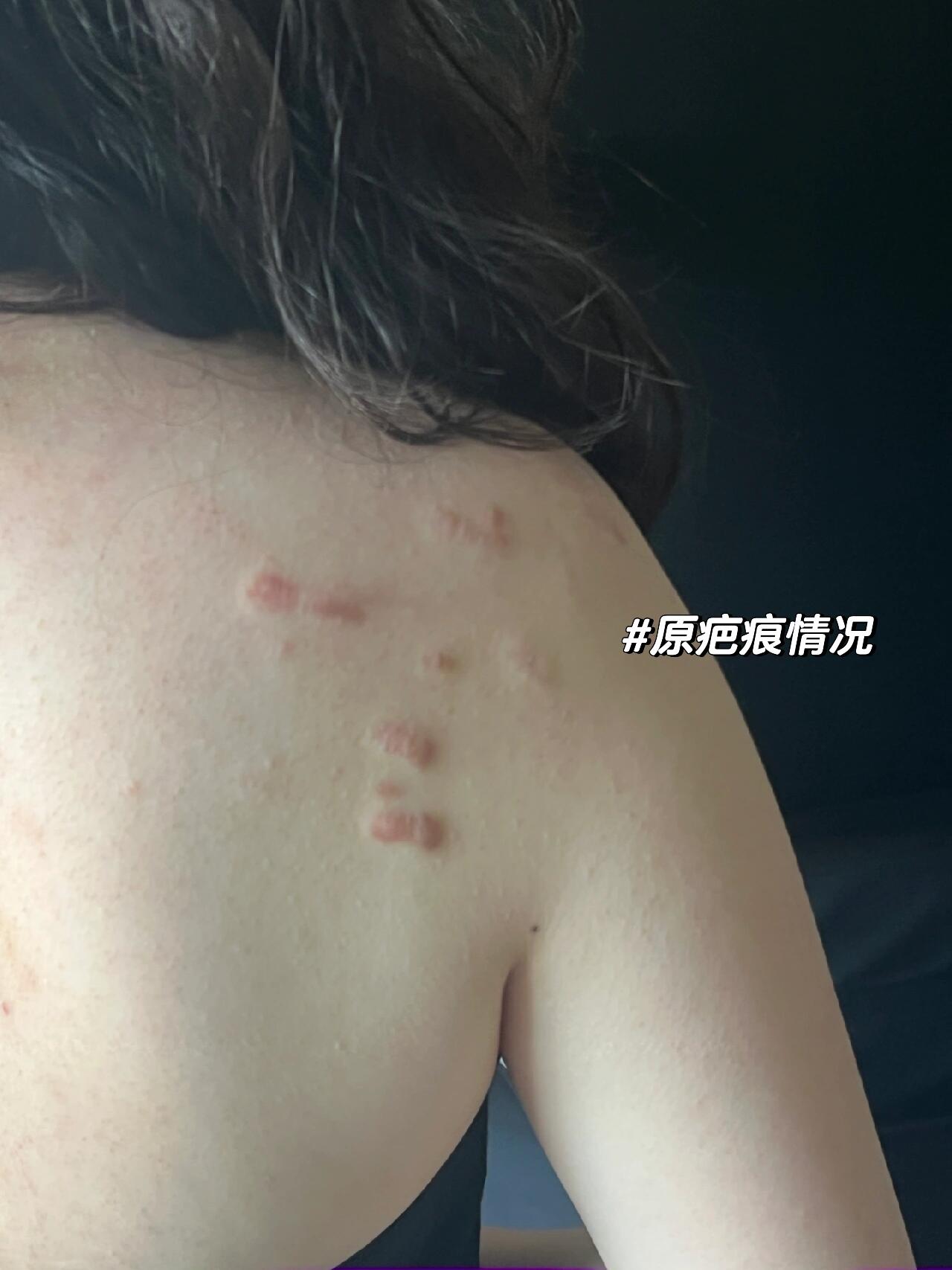 遮盖增生凸起的水痘疤痕 98 女生纹身