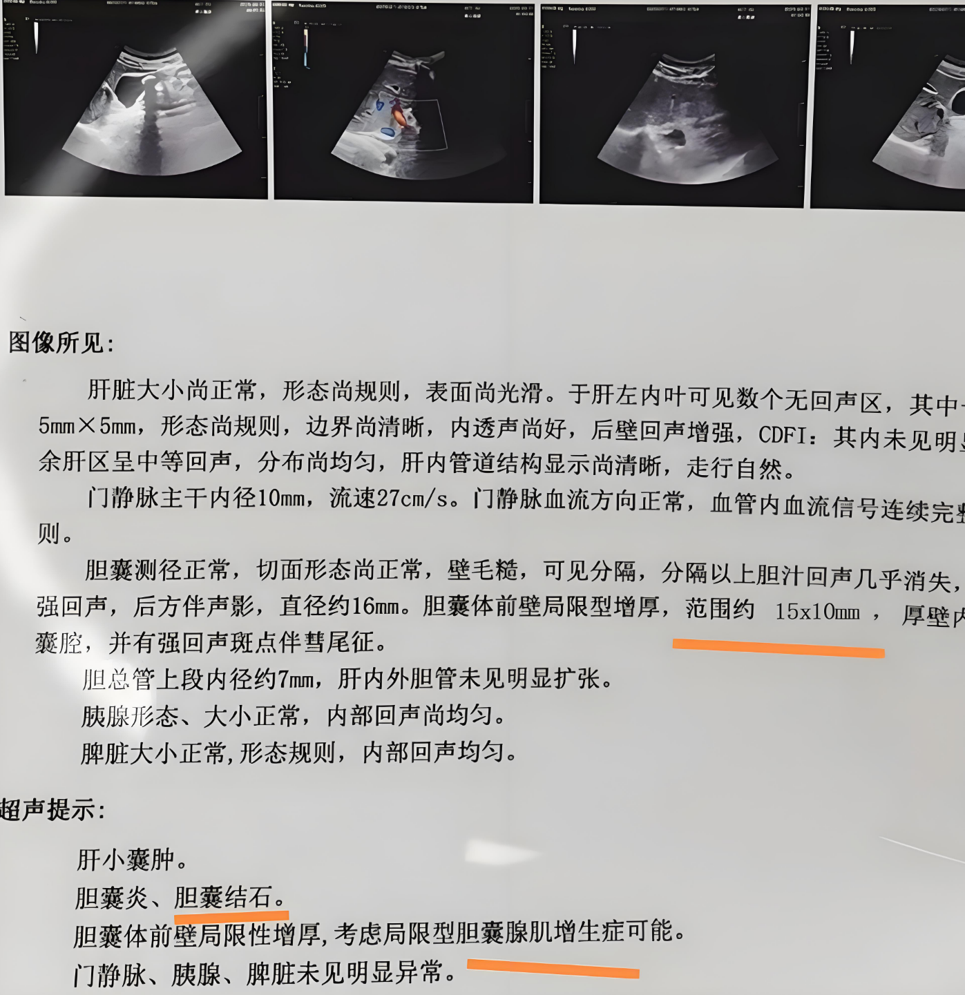 胆囊腺肌症15x10mm需要尽快处理,最好选择手术切除