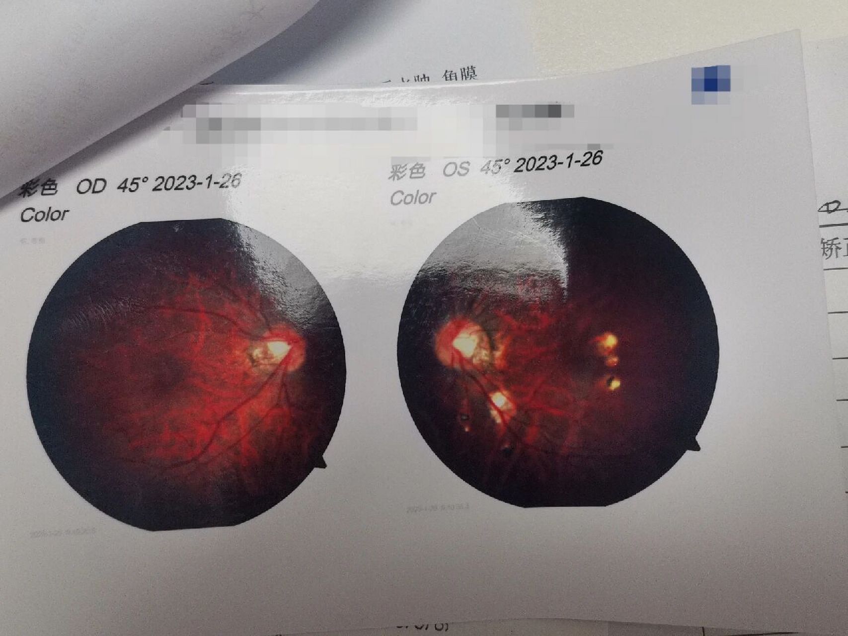 20岁脉络膜新生血管图片