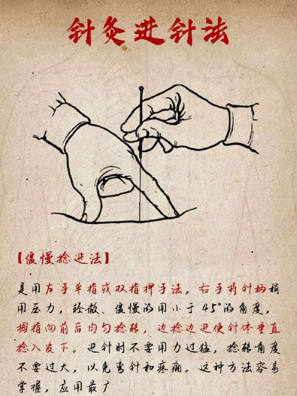 中医古法针灸进针法,针灸进针原来这么讲究 不管是在武侠小说中,还是