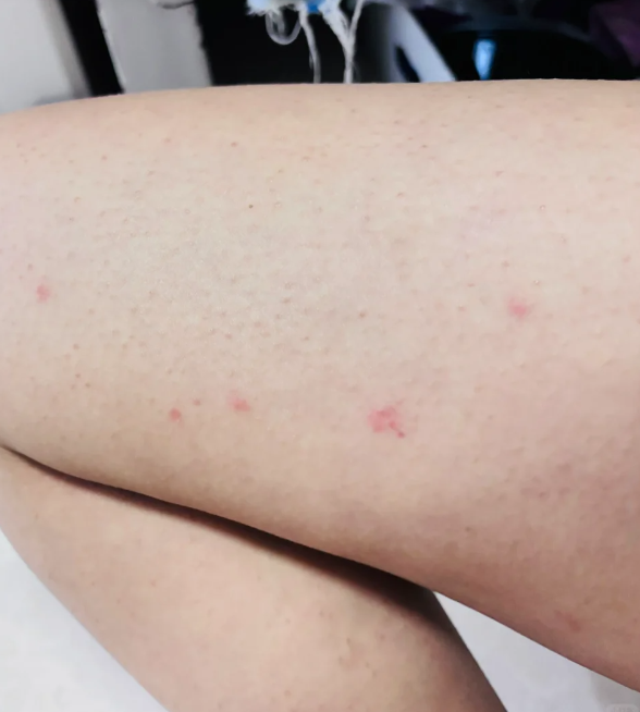 大腿内侧长痘痘还带脓包,最常见的就是细菌感染引起的化脓性毛囊炎