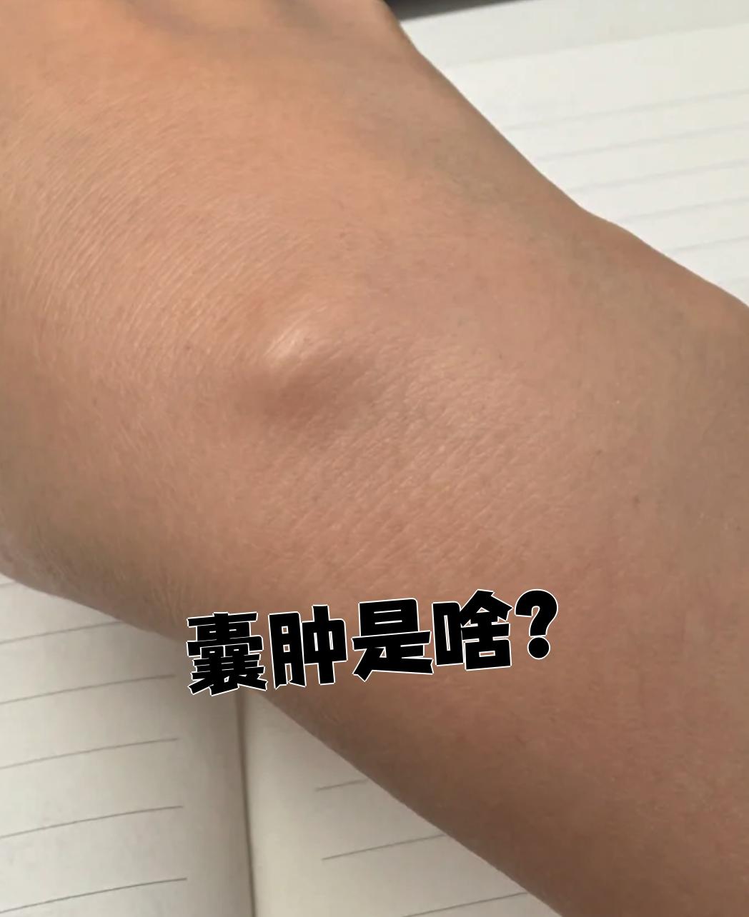 囊肿就是外面包着一层囊壁,里面装着液体或其他东西的包块