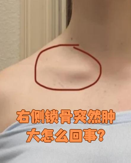 右侧锁骨突然肿大可能由外伤或胸锁关节炎引起,需要根据具体原因