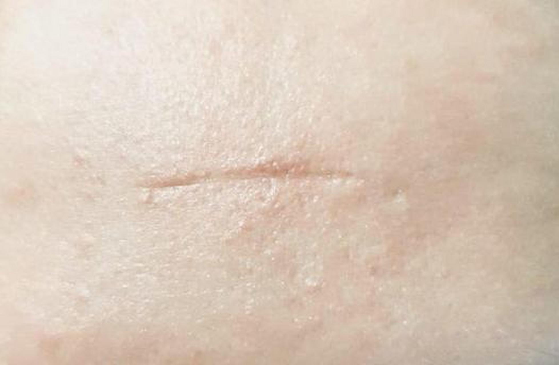 丰胸手术的技术细节决定了手术的效果和疤痕的位置.