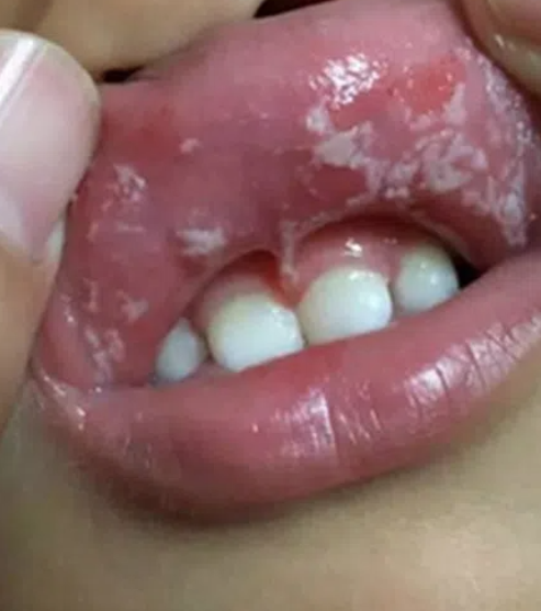 牙龈出现白色膜最常见的原因是口腔溃疡前期或鹅口疮