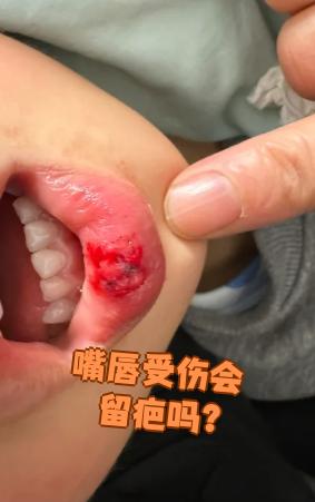 嘴唇受伤会不会留疤,主要看两点:一是患者是不