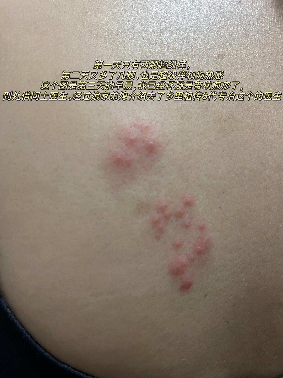 今年的新毒株吗?带状疱疹