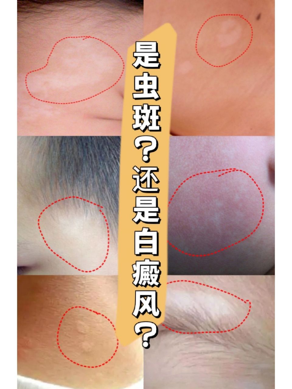 孩子皮肤上的是虫斑还是白癜风?