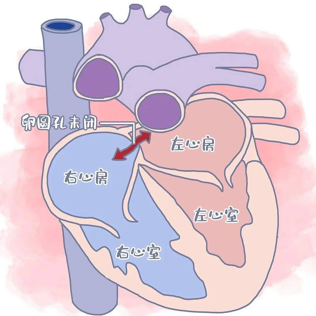卵圆孔未闭——偏头痛70 术后苏醒篇76 95当一个人极度痛苦却