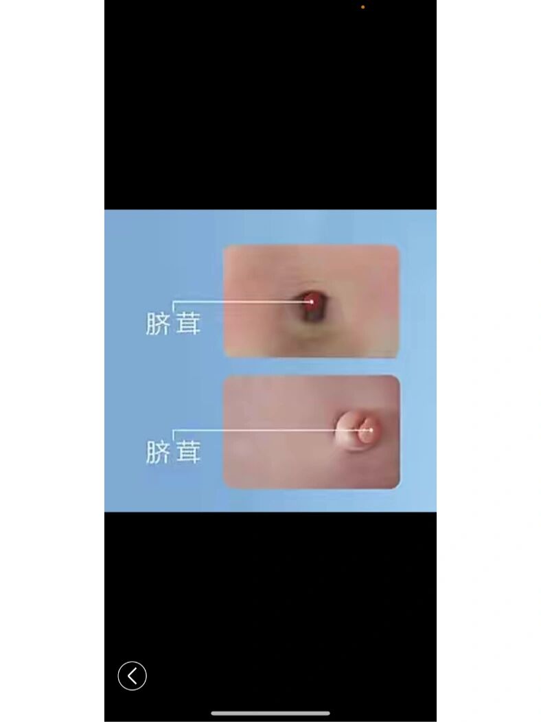 新生儿 脐茸篇