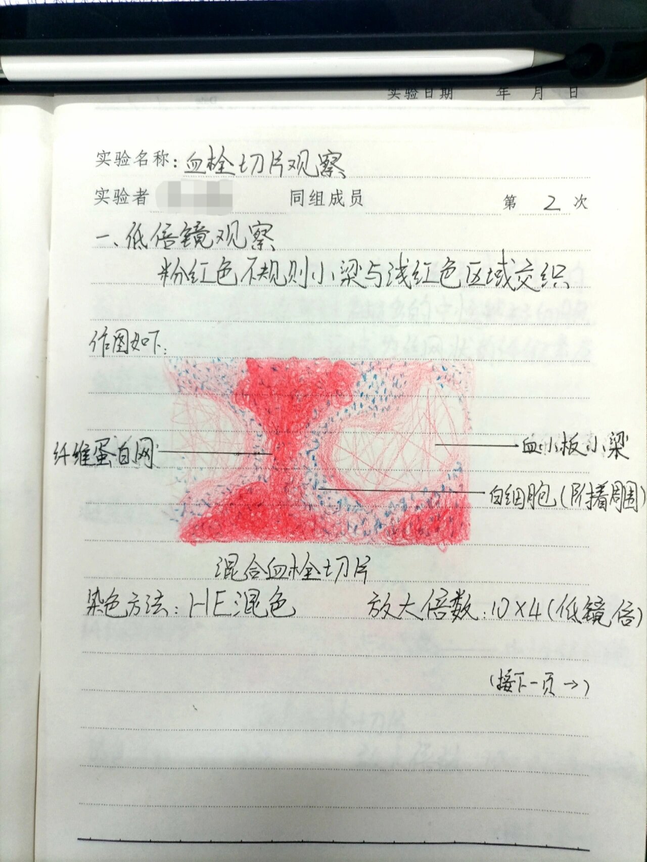 混合血栓切片观察(低倍镜和高倍镜)