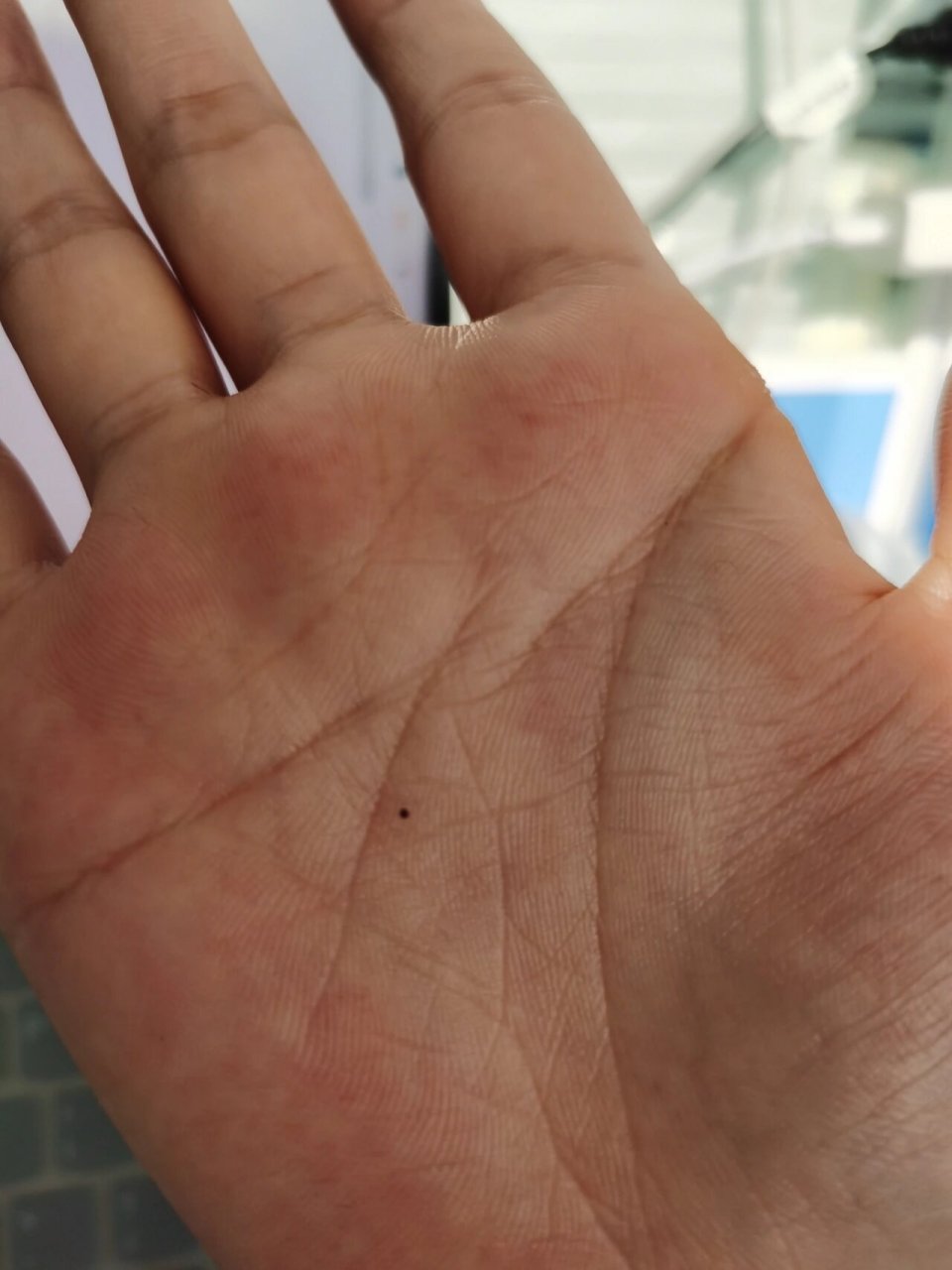 手掌心突然长了一颗痣 前几天还没有,今天突然发现手掌心长了一颗痣