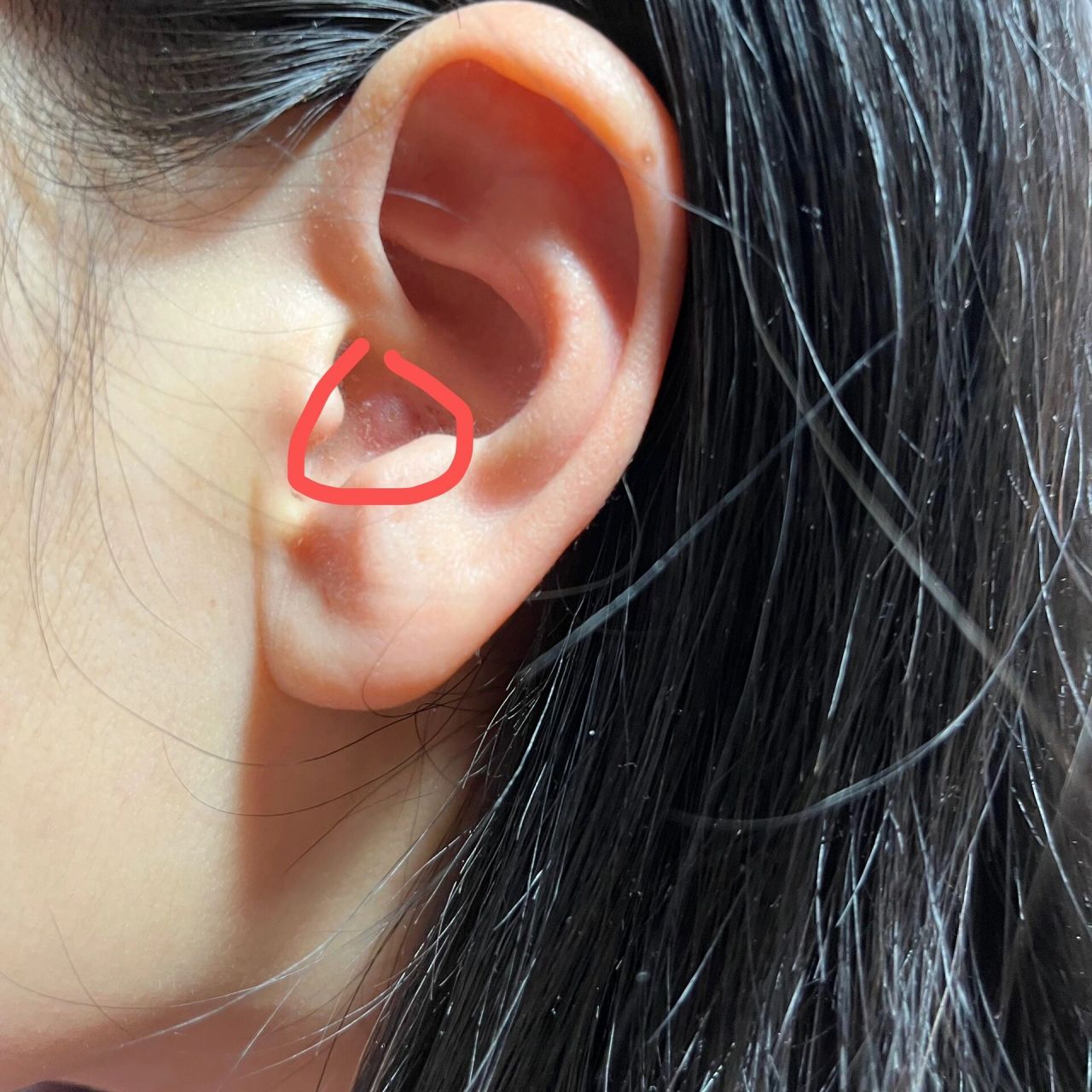 耳朵上长了一个包,好疼啊,还是不小心摸到的