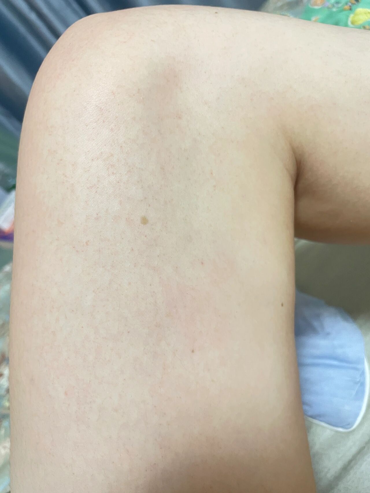 暴晒后腿上都是针尖出血点