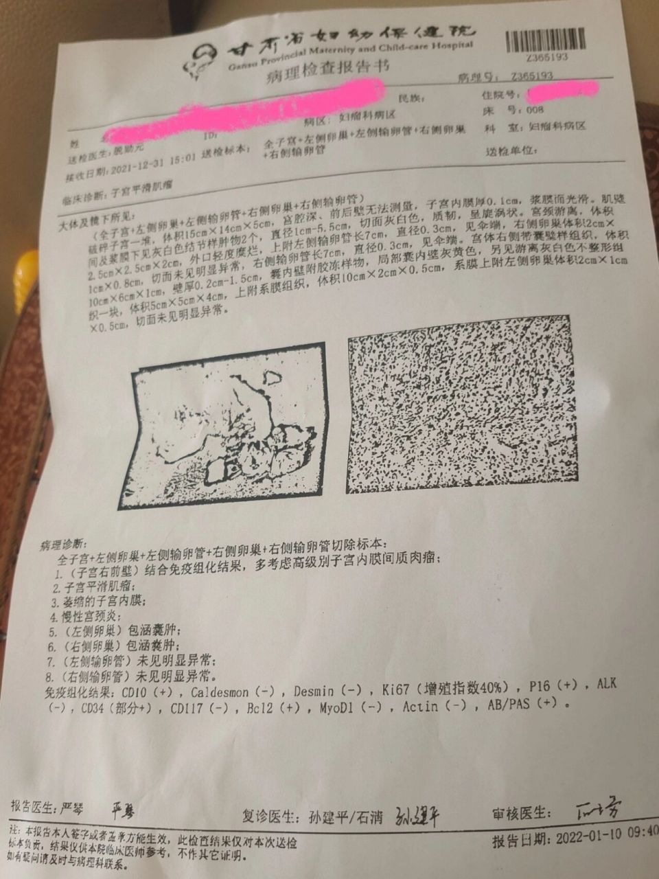 恶性子宫肌瘤图片