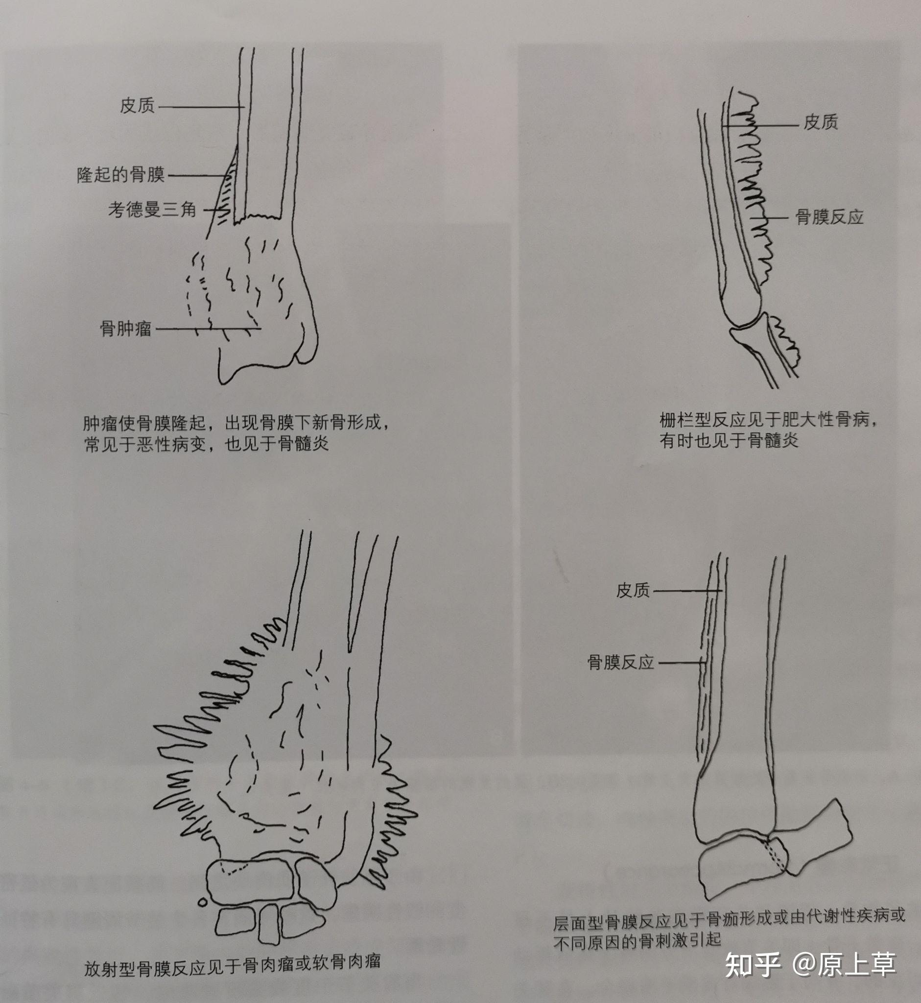 骨膜反应的x线片影像