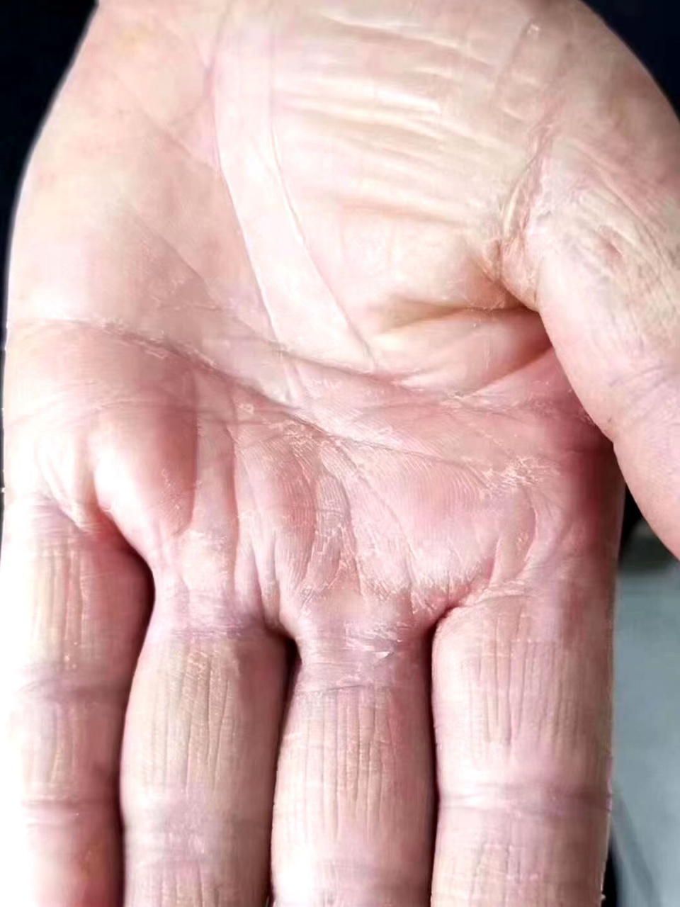 掌跖脓包病 掌跖脓疱病,发生于手掌和足跖的脓疱性皮肤病,反复发作