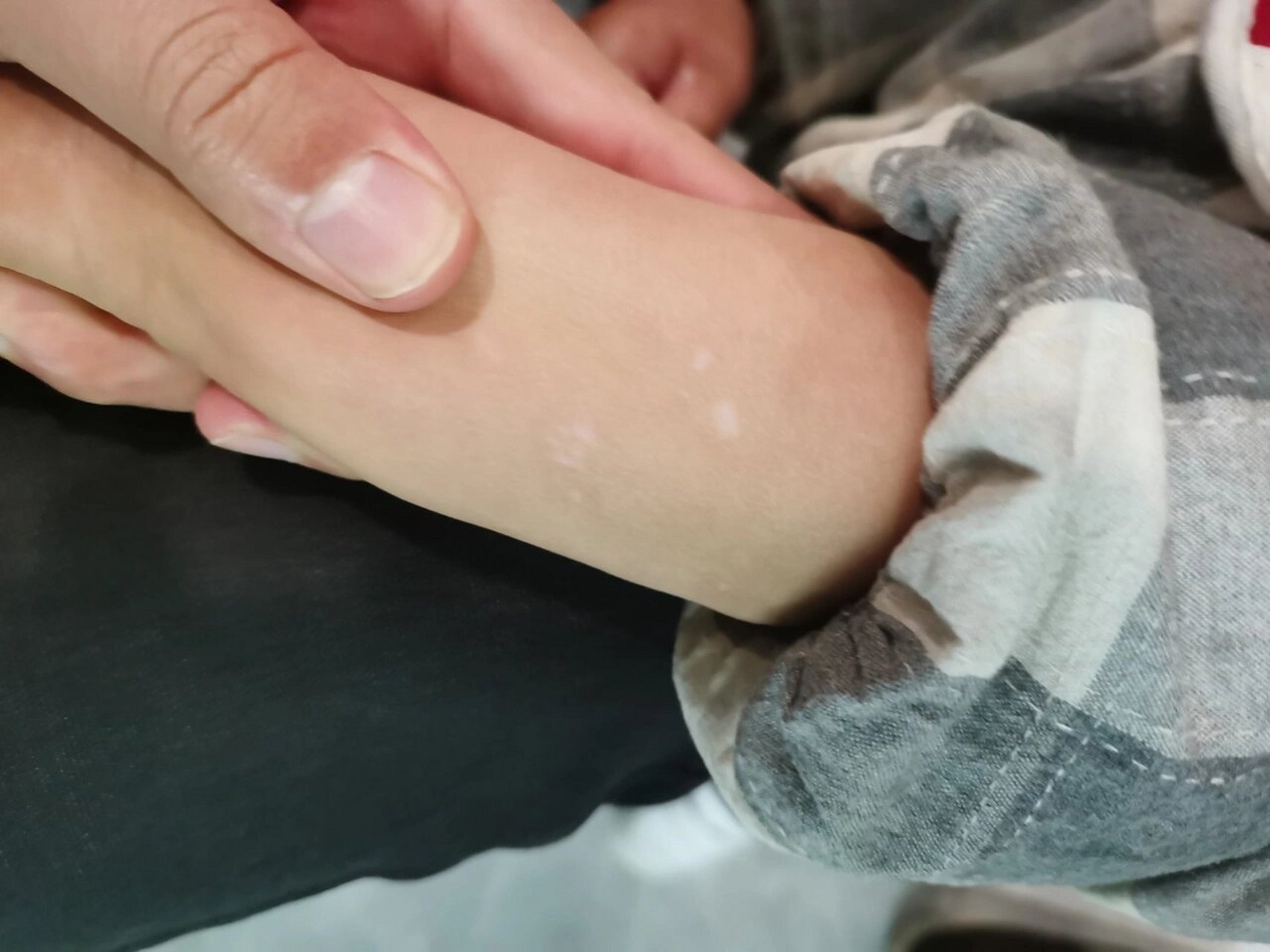 宝宝手上白色斑点 宝宝最近手上出现这种白色斑点,大家有遇到过么?