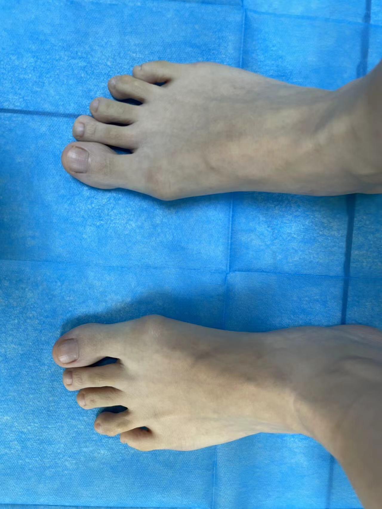 随着病情发展,大脚趾关节处疼痛会愈发明显且频繁