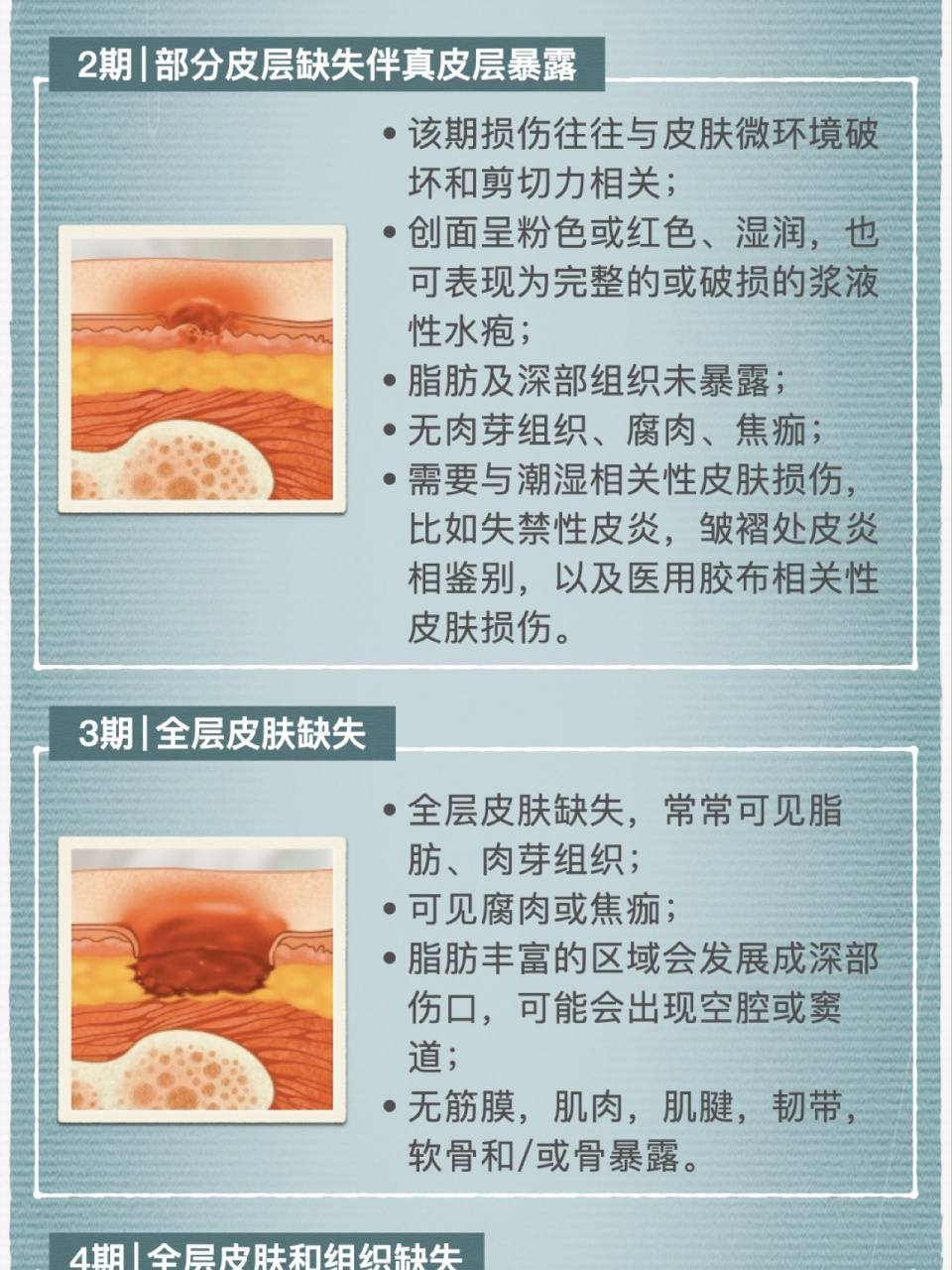 褥疮的分期和临床表现