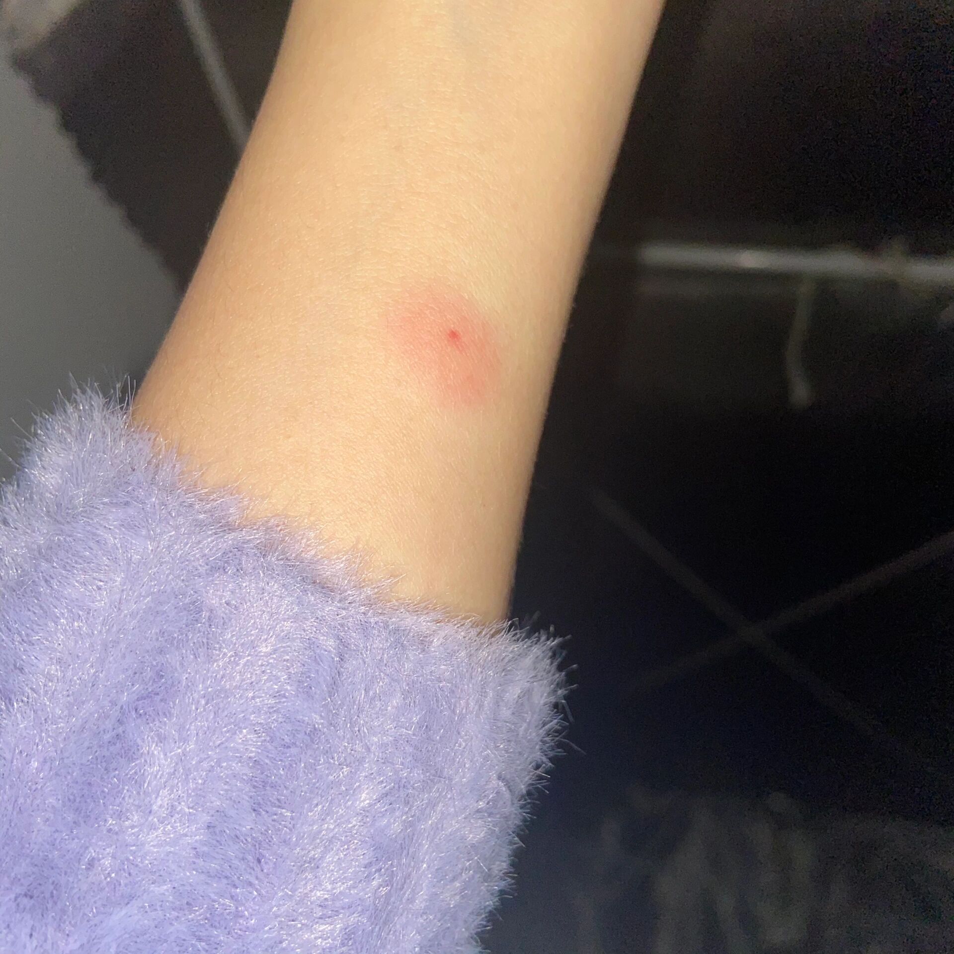 结核菌素试验 相当于皮试 三天前打了一针 慢慢出现像被叮了一样的