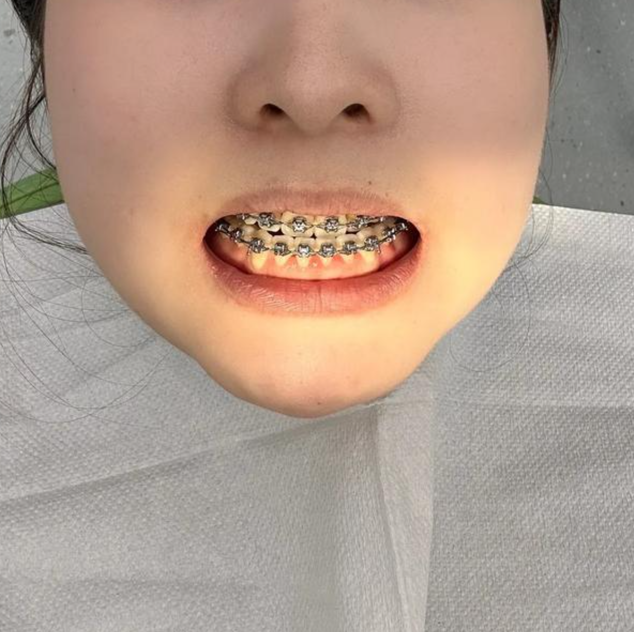 如果上颌骨突出还伴有牙齿外凸,建议先做牙齿矫正