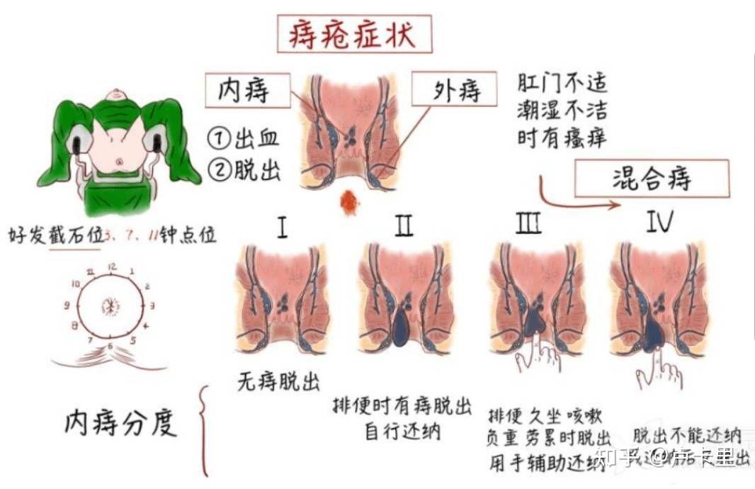 外痔疮外痔图片