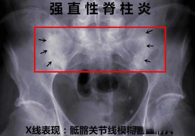强直性脊柱炎说到底的根本病因无非是先天禀赋不足,督脉空虚